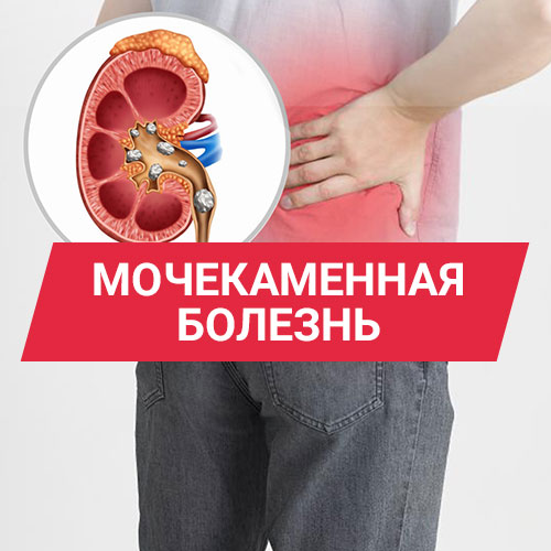 Мочекаменная болезнь: симптомы, диагностика и современные методы лечения