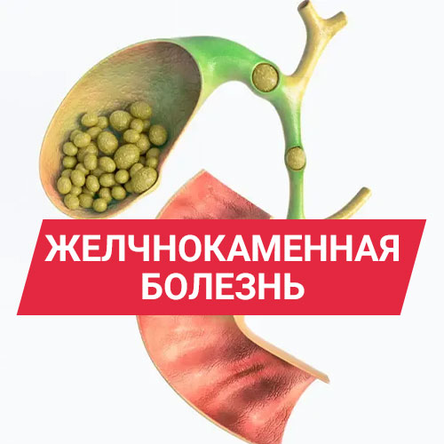 Желчнокаменная болезнь (ЖКБ): диагностика, лечение и симптомы