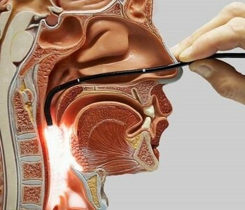 Трансназальная гастроскопия Трансназальная гастроскопия